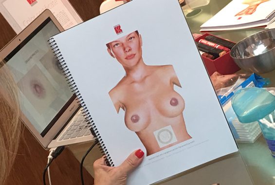 areolas